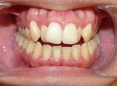 Image result for invisalign first